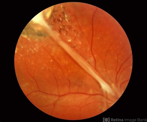 Ocular Toxocariasis A Rare Encounter In A 10 Year Old Female