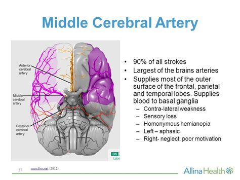 Image Result For Middle Cerebral Artery Stroke Symptoms Stroke