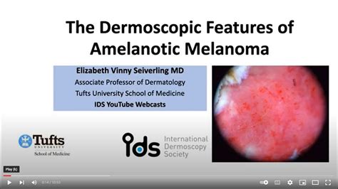 Amelanotic Melanoma Dr V Seiverling Youtube
