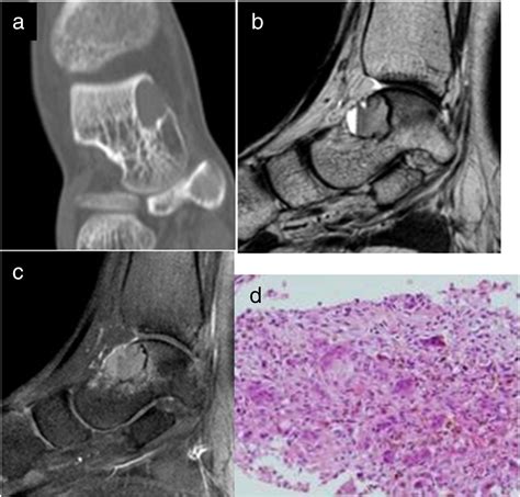 Imaging Findings Of Various Talus Bone Tumorsclinicoradiologic