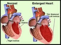 Myocarditis (mk) is a cardiovascular disease characterized by heart muscle damage due to the development of inflammation in the tissues of the organ. Cardiomegaly - Definition, Symptoms, Causes, Diagnosis and ...