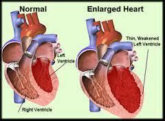 Myocarditis is defined as an inflammation of the cardiac muscle. Cardiomegaly - Definition, Symptoms, Causes, Diagnosis and ...