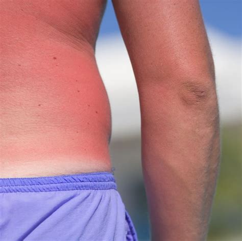 Man With Sunburnt Back Mid Section Close Up Severe Sunburn Sunburn