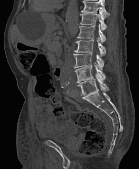 Multiple Lytic Lesions Seen For Example In L4 L5 Vertebral Bodies