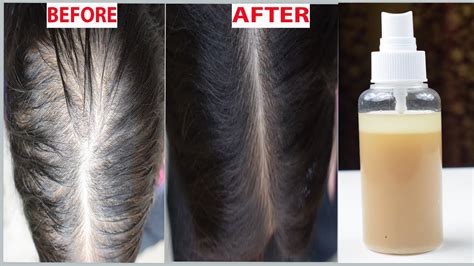 Magical Diy Natural Hair Growth Serum Super Fast Secret Regrowth Hair