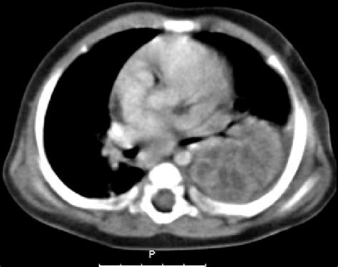 B A Contrast Enhanced Ct Image Of The Chest At The Level Of The Left