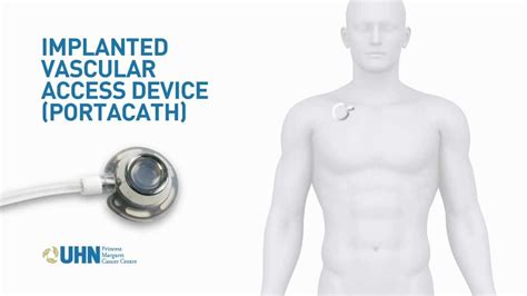 Port A Cath Implanted Vascular Access Device Youtube