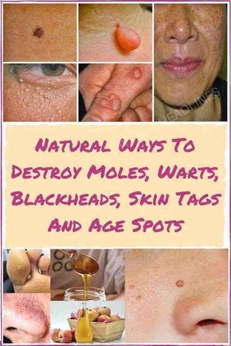 Natural Ways To Remove Moles Warts Blackheads Skin Tags And Dark