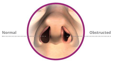 Vivaer® Treatment For Nasal Obstruction New York Ent