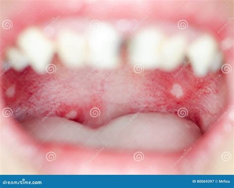 Infection Of Ulcer Inside Mouth Stock Image Image Of Aphtha Care