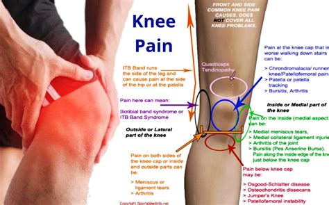 Knee Pain Homeopathic Treatment Right Knee Left Knee By Dr Makkar My