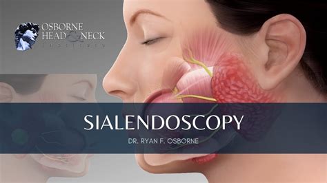 Sialendoscopy Procedure For Parotid Gland Stones Explained By Dr Ryan
