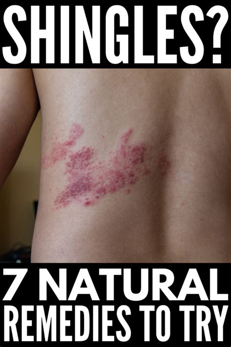 Natural Remedies For Shingles 7 Home Treatments That Help
