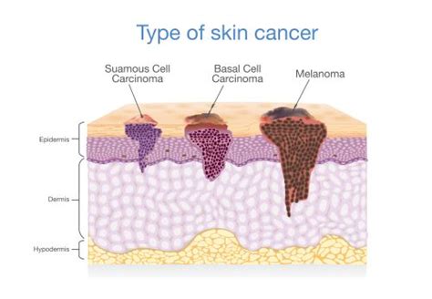 Different Types Of Skin Cancer Treatments