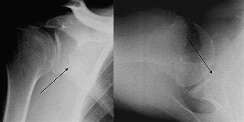 Arthroscopic Reduction And Cannulated Screw Fixation Of A Large