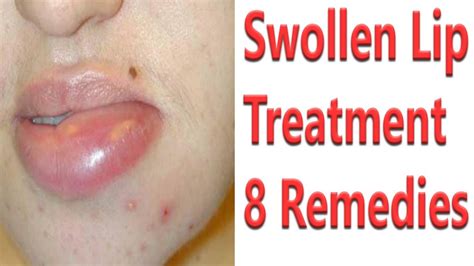 Home Remedies For Swollen Lips 💖top 5 Easiest Home Remedies For Swollen Lips Youtube