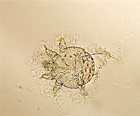 Scabies Microscope