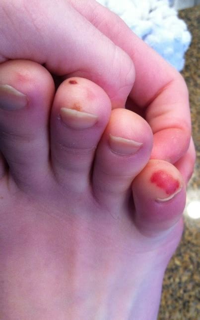 Symptoms Of Chilblains On Toes