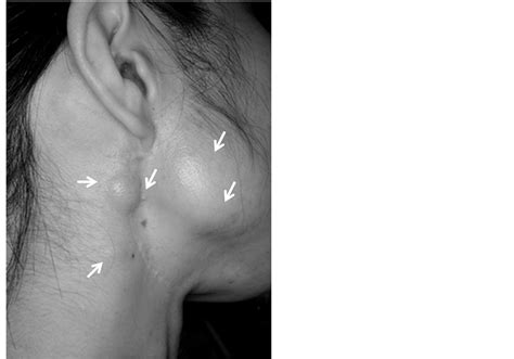 A Case Of Pleomorphic Adenoma Of The Parotid Gland With Multiple Local Recurrences Through