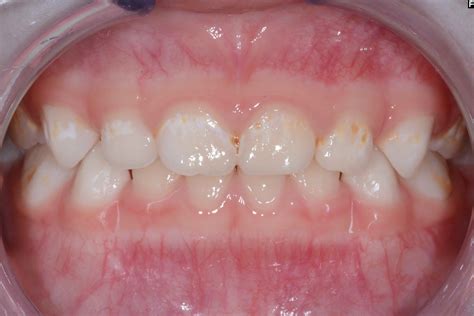 Early Childhood Caries Symptoms White Spot Lesions Tooth Decay Pain