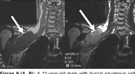 Figure 1 From Malignant Brachial Plexopathy A Pictorial Essay Of Mri