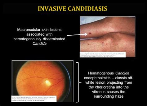 Invasive Candidiasis Health And Medical Information