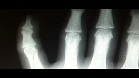 finger fracture x ray findings treatment youtube