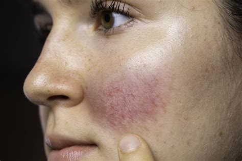 Learn About The 5 Most Common Rosacea Triggers David Rodriguez Md