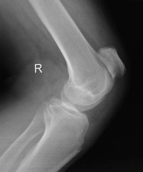 Patellar Tendon Rupture Radiologic And Ultrasonographic Findings The