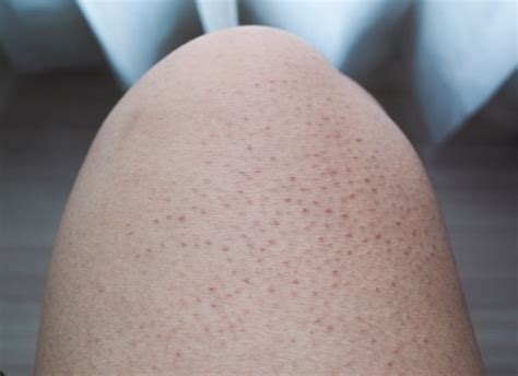 Keratosis Pilaris Itchy And Dry Skin Treatment Retone
