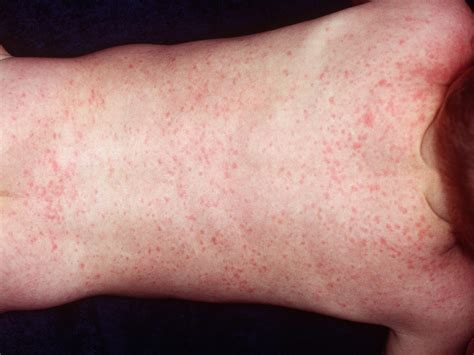 Childhood Rashes Skin Conditions And Infections Photos