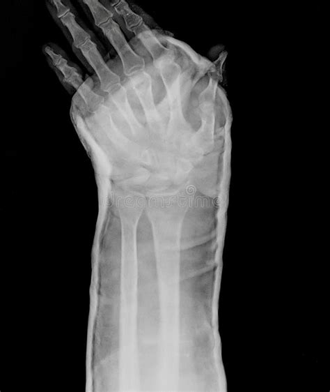 X Rayed Human Left Hand X Ray Of Hand Bones Stock Image Image Of