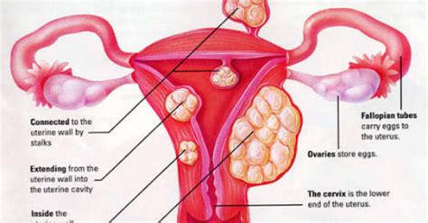 Kinfo Enternatiment A Glance Through Uterine Fibroid