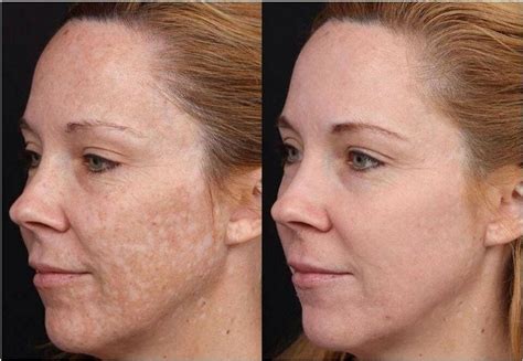 Prx Pigment Skin By Design Dermatology And Laser Center Pa