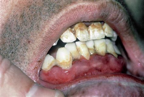 Oral Bleeding In Scurvy Photograph By St Bartholomew Hospitalscience