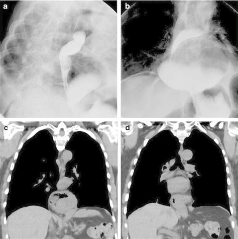 Upper Gi Series A B And Ct Chest C D Of A Patient With A