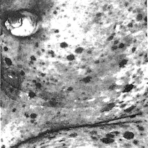 Electron Micrograph Of The Patients Hyperpigmented Macule A Basal