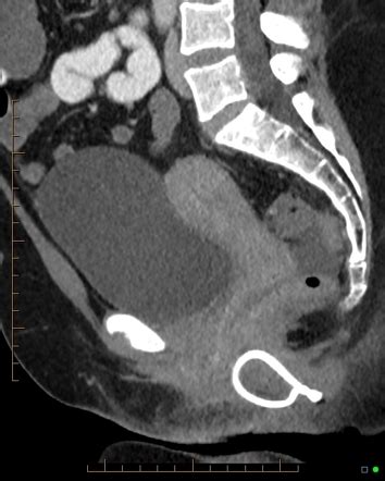 Perianal Fistula With Seton Tube Radiology Case Radiopaedia Org