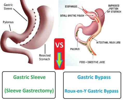 Sleeve Gastrectomy Vs Gastric Bypass Whats The Difference