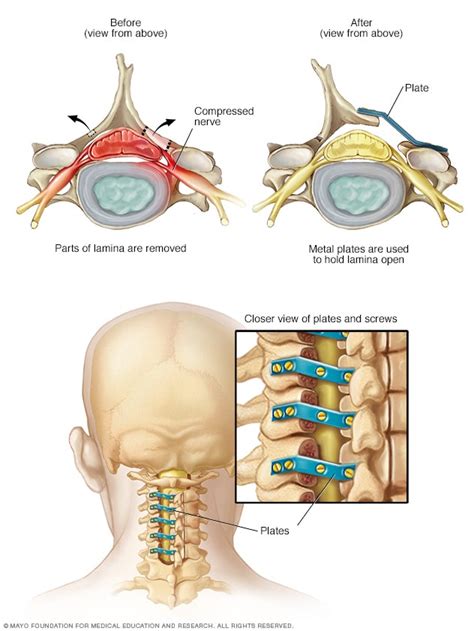 Cervical Spinal Stenosis Neck Surgery My Xxx Hot Girl