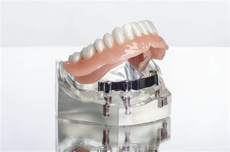 Implants Dentures Holt Dentures