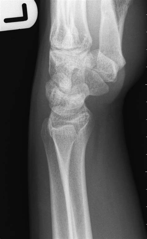 Normal Lateral Wrist Radiograph Image