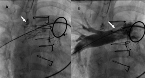 Hybrid Intraoperative Pulmonary Artery Stent Placement For Congenital