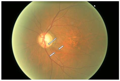 Retinal Nerve Fiber Layer Defect Fundus Photo Of The Left Eye