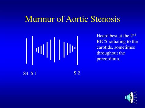 Ppt Aortic Stenosis Powerpoint Presentation Free Download Id4501578