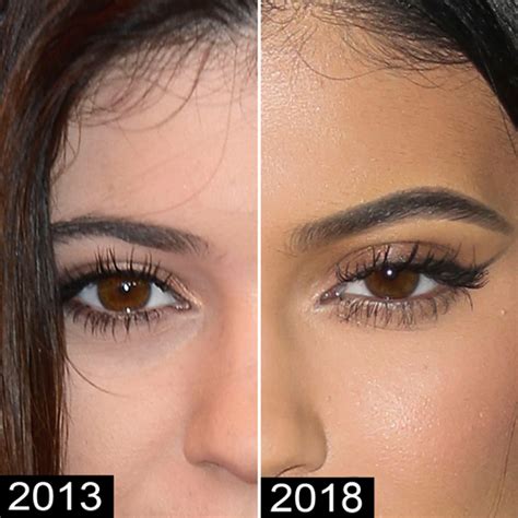 Yes, we are going to present you some images with highights how kylie jenner before plastic. Kylie Jenner before and after surgery - Yve-Style.com