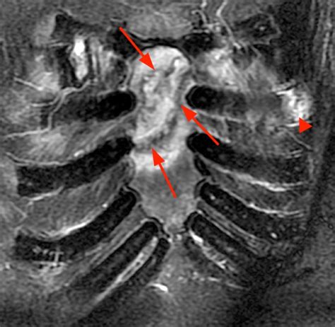 Costal Cartilage Injuries Radsource