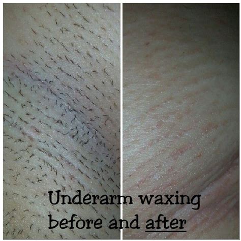 Waxing Before And After With Nufree Wax Underarm Waxing Spa Life