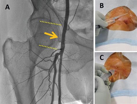 Basics Of Angiography For Peripheral Artery Disease Intechopen