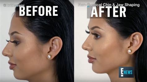 non surgical chin augmentation by dr ghavami e news youtube
